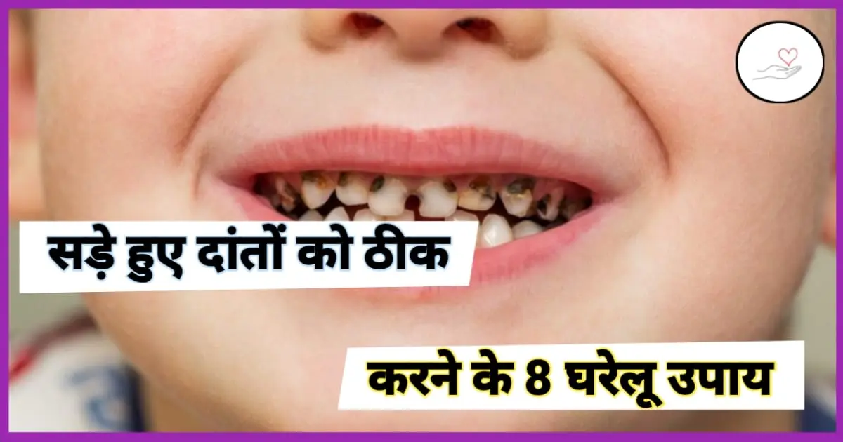 सड़े हुए दांत का घरेलू उपाय : Tooth Cavity Home Remedy In Hindi